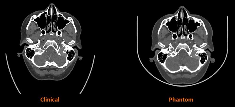Comparison of Human CT Scan vs. CT Scan of Stratasys' 3D Printed Phantom.jpg