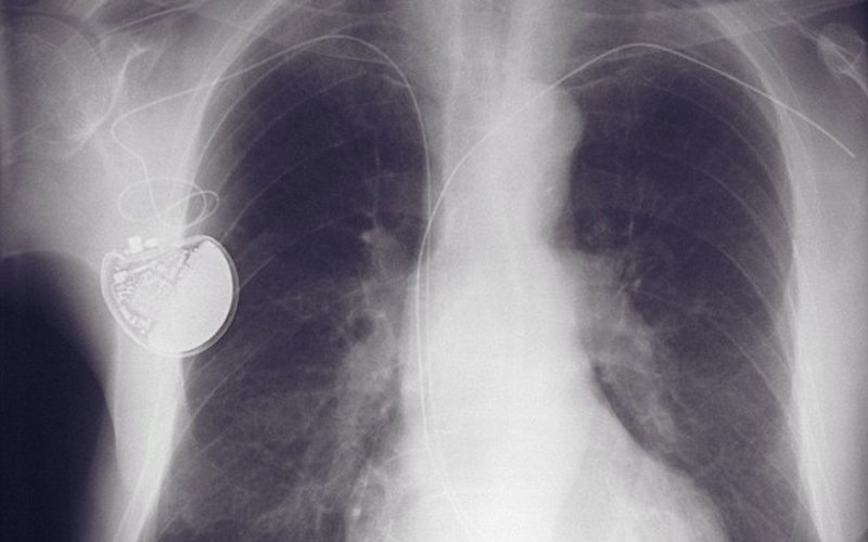 pacemaker x-ray.jpg