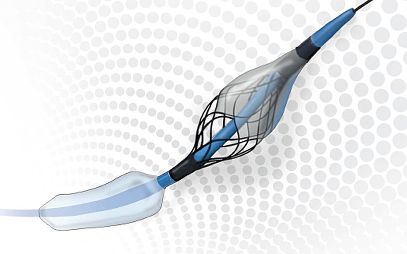 Contego Medical has announced the European commercialisation of its Paladin carotid post-dilation balloon, the first angioplasty balloon with Integrated Embolic Protection (IEP) technology.jpg