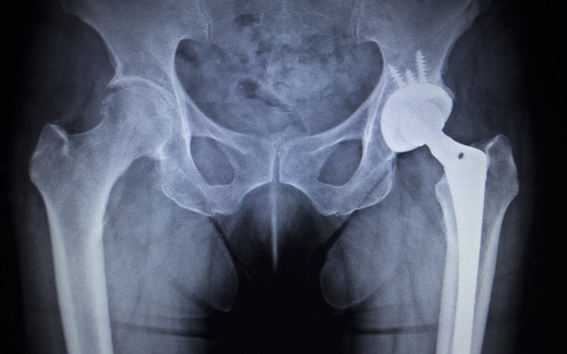 hip implant.jpg