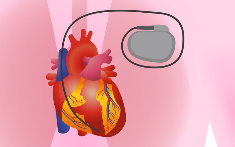 Biotronik pacemaker.jpg