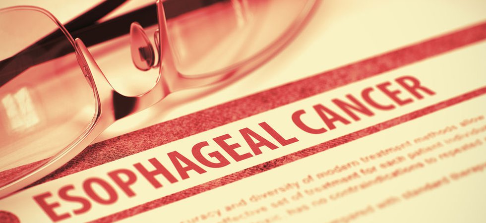 Oesophageal Cancer