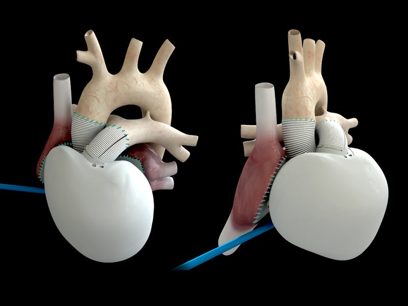 First In Man Implantation Of Carmats Bioprosthetic Artificial Heart